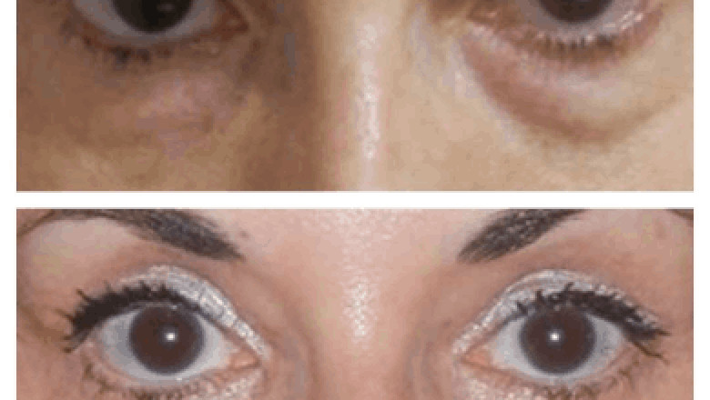 Sleep positions after Eye bag removal in Dubai
