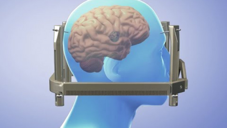 Stereotactic Surgery Devices Market to Witness High Growth Owing to Advanced Imaging