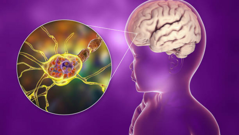 Tay-Sachs Disease Treatment Market to See Strong Growth Owing to Gene Therapy Innovations