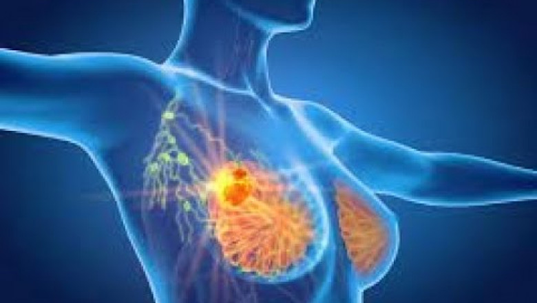 Triple Negative Breast Cancer Treatment Market Grows on Targeted Therapy Advances