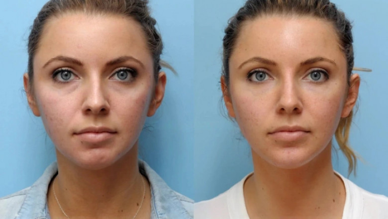 What to Expect Before and After a Thread Lift with the Best Plastic Surgeon in Dubai