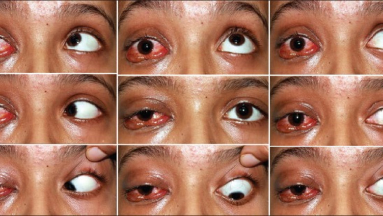 Global Ophthalmoplegia Market is Anticipated to Witness Growth Owing to Innovative Therapies