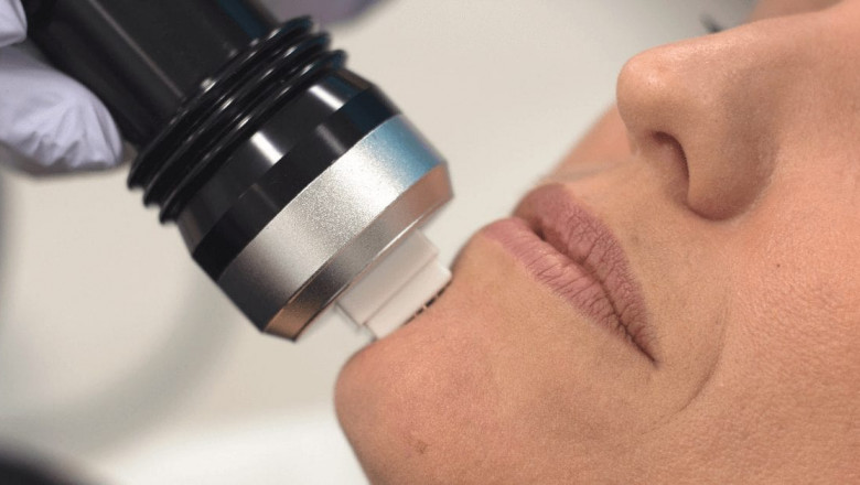 Transform Your Skin with the Power of Fractional RF Microneedling