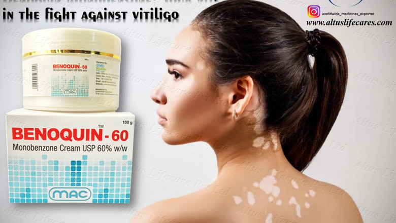 Doctors Are Stunned by the Results of Benoquin Cream 60 on Vitiligo!
