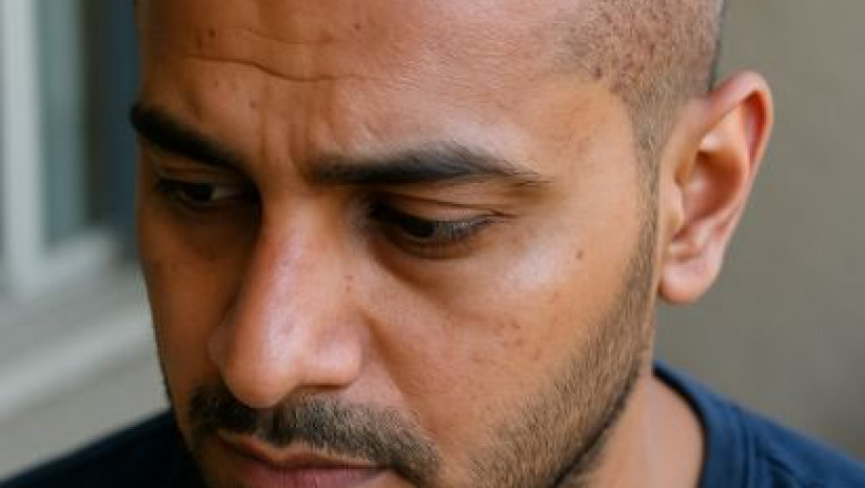 Healing Revolution: Rethinking Hair Transplant Recovery