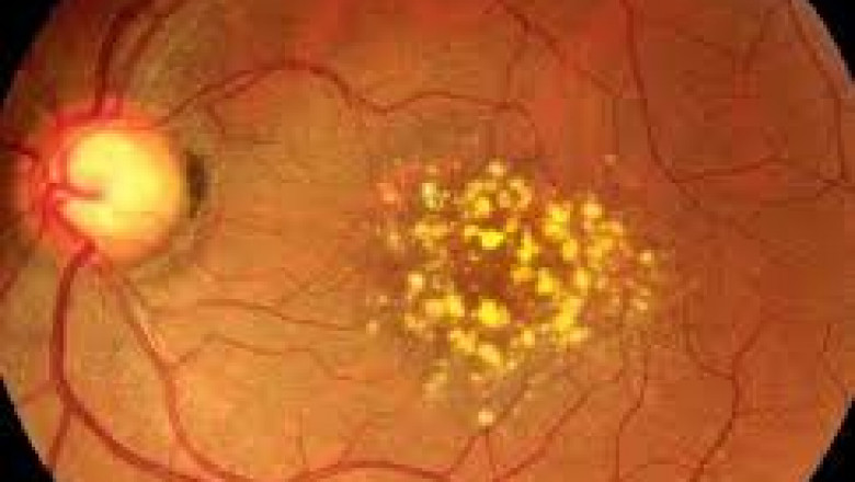 Intermediate AMD Market to Soar with Demand for Advanced Therapies