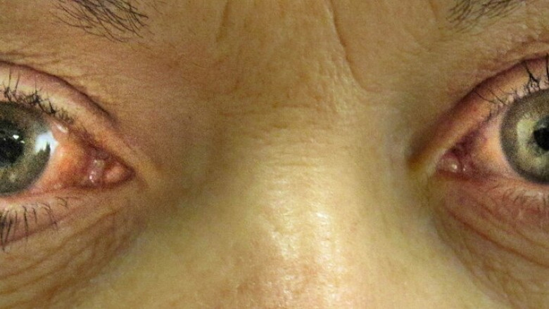 Ocular Hypertension Market to See Growth with Advanced Therapeutics