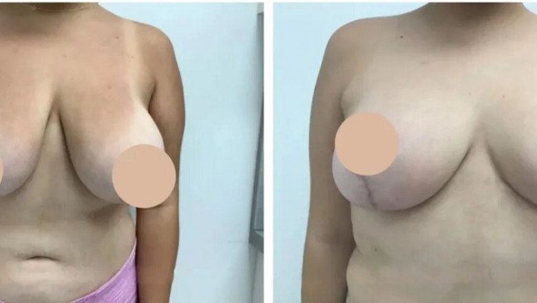 Choosing the Best Breast Lift Surgeon in dubai: Is Experience More Important Than Reputation?