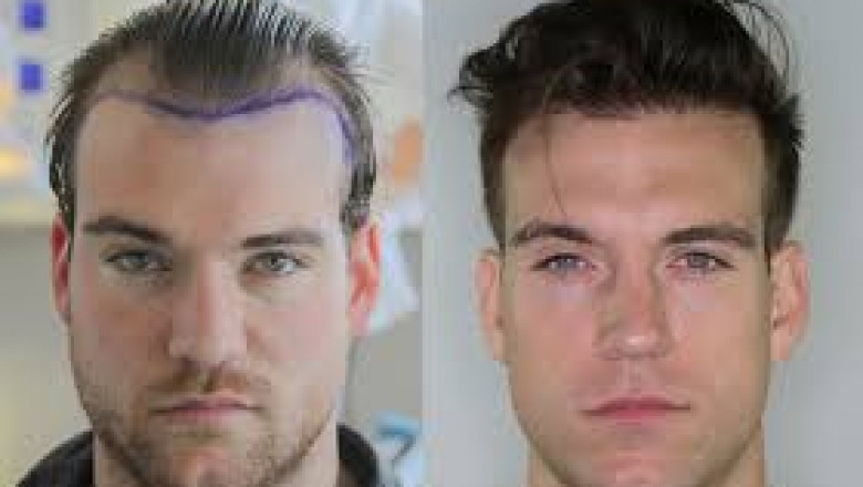 Hair Transplants in Beverly Hills: Costs, Techniques, and Top Surgeons