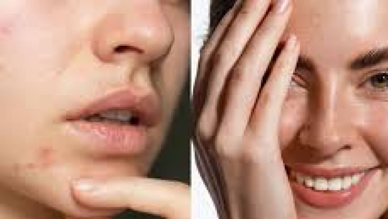 Anti-Acne Cosmetics Market Consumer Preferences Shifting Toward Dermatologist-Tested and Clinically Proven Formulations