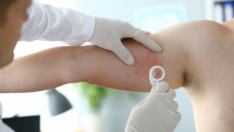 Chronic Idiopathic Urticaria (CIU) Treatment Market  to Grow on Rising Biologic Adoption