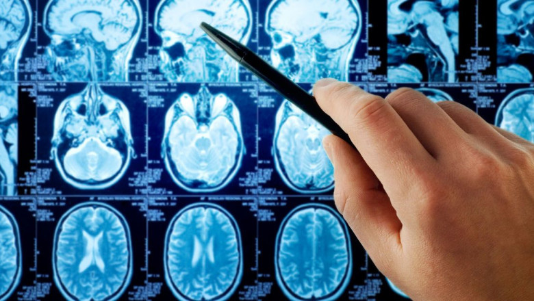 Clinically Isolated Syndrome Market Poised for Growth due to Early Diagnosis