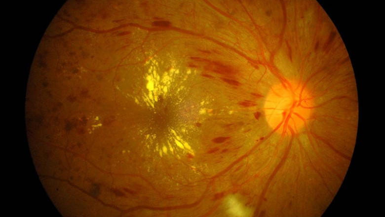 Diabetic Macular Edema Market to Grow Owing to Rising Diabetes
