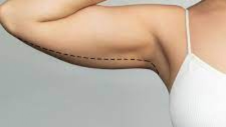 Choosing the Right Surgeon for Your Arm Lift in Jeddah
