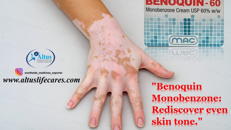 Benoquin 60% Cream for Vitiligo: Transforming Skin Tone with Monobenzone