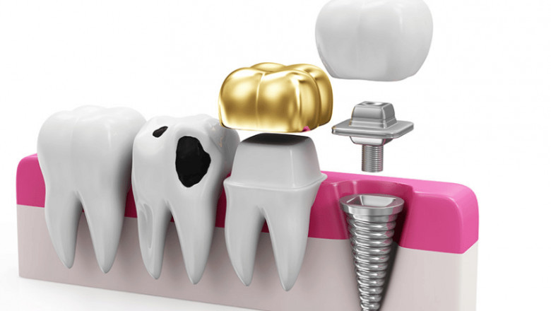 Book Restorative Dentistry Services in Mississauga – Restore Your Smile Today