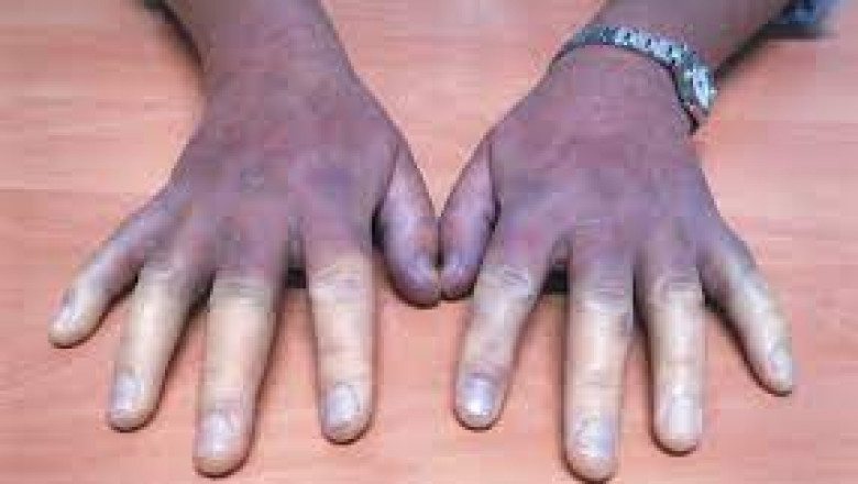 Buerger’s Disease Market: Insights, Innovations, and Future Opportunities