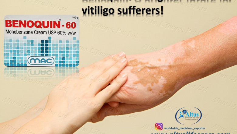 Everything You Should Know About Using Benoquin Cream 60% for Vitiligo