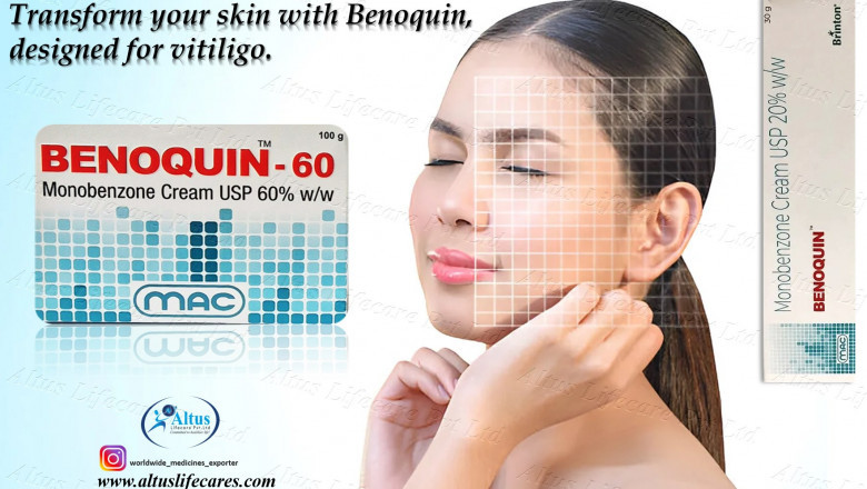 How Benoquin Monobenzone 60% Cream Helps Achieve a Uniform Skin Tone for Vitiligo Patients