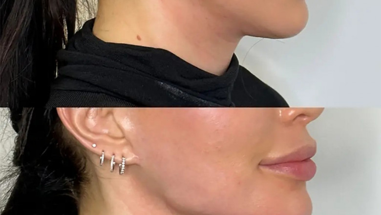 Jawline Fillers in Dubai: What You Can Expect During Your Treatment