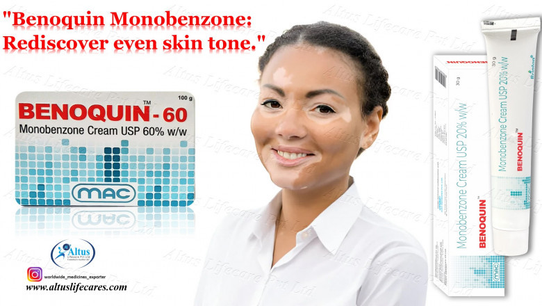 Monobenzone Cream Magic: Watch Vitiligo Disappear Live Before Your Eyes!