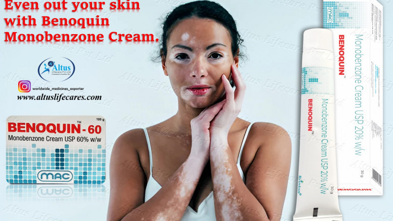 Monobenzone Cream: The Breakthrough Treatment for Vitiligo You Need to Try Now!