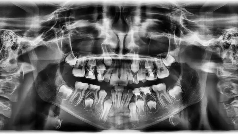 Panoramic Dental X-Ray Cost Explained: What to Expect