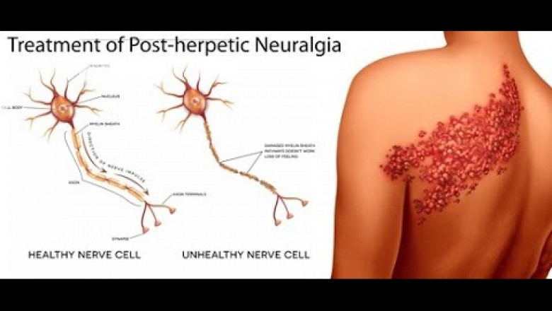 Postherpetic Neuralgia Market Set to Grow with Neuromodulation Advances