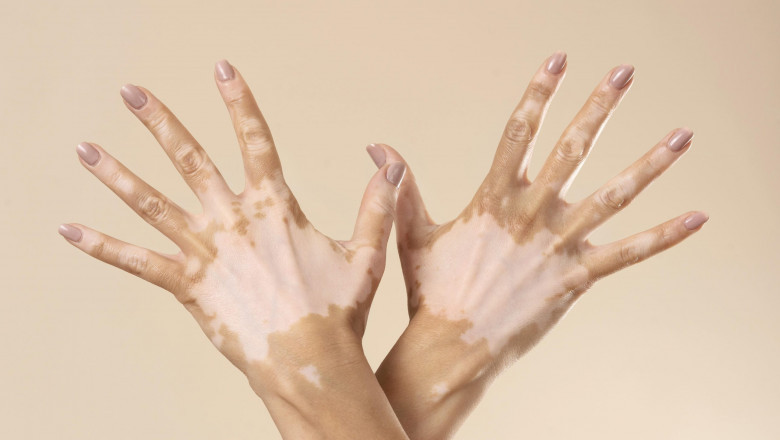 Pyoderma Gangrenosum Treatment Market Projected to Grow via Biologics