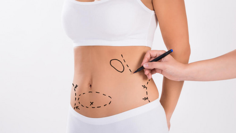 Reclaiming Self-Assurance The Psychological Impact of Liposuction in Dubai