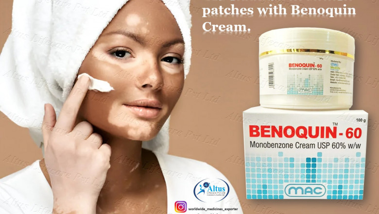 Treating Vitiligo with Benoquin Cream 60: Effectiveness, Side Effects, and More