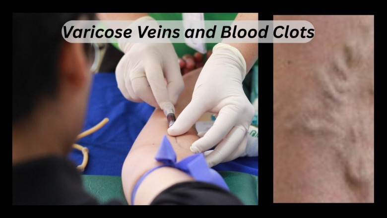 Varicose Veins and Blood Clots: Understanding Connection and Risks