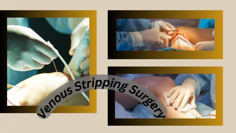 When Should You Consider Venous Stripping Surgery?