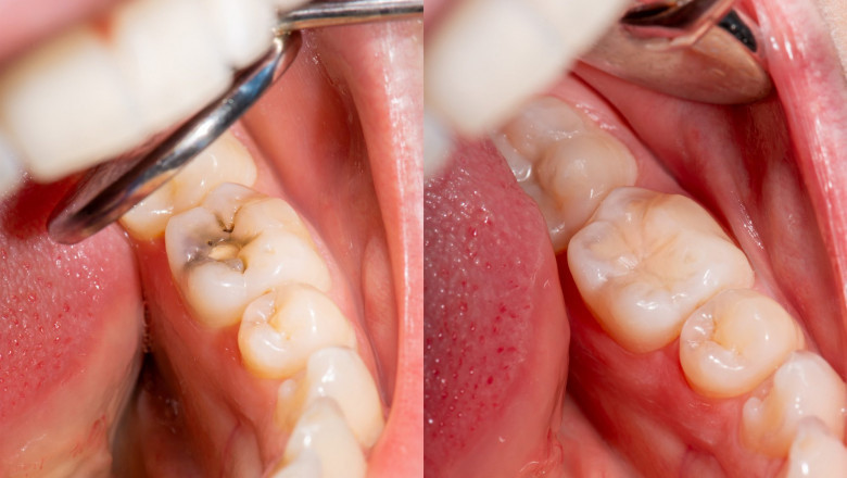 Your Guide to Understanding Tooth Filling Cost