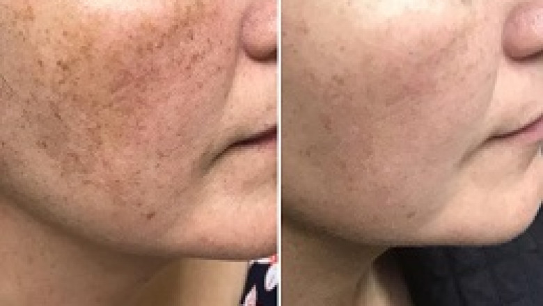 Does Pico Laser Hurt? Pain Level Explained