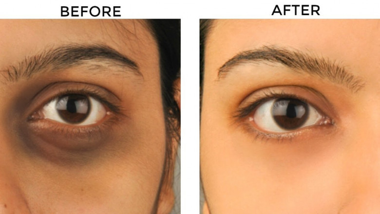 Is It Safe to Get Under-Eye Fillers in Islamabad?