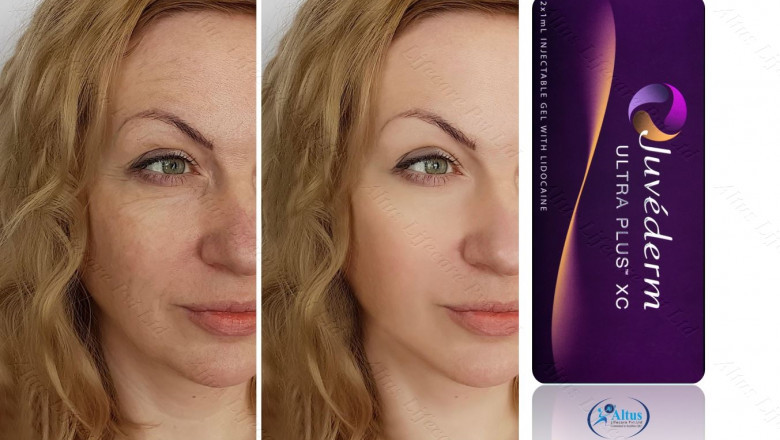Juvederm Ultra Plus XC Cost Comparison Revealed! Bargain or Bust?