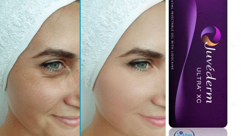 Juvederm Ultra XC Injection: Your Secret to Plump, Youthful Skin