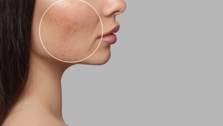 The Evolution of South Korea Professional Acne Medication Market: The Impact of K-Beauty Brands on Acne Care