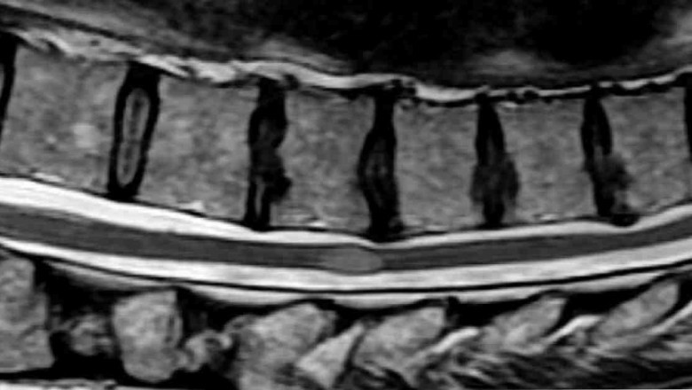 Transverse Myelitis Market to Grow with Advanced Therapies
