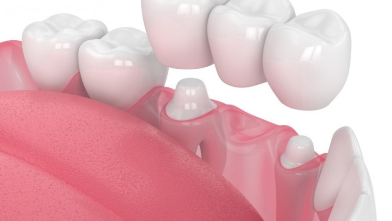 Are dental crowns and bridges permanent?