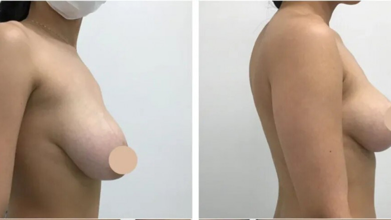 How to Choose the Best Breast Lift Surgeon in dubai Based on Your Desired Results