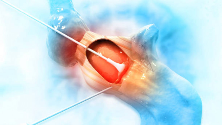Laser treatment for hemorrhoids in Riyadh: a quick and effective solution