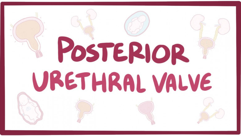 Specialized Posterior Urethral Valve Care in Delhi for Male Newborns