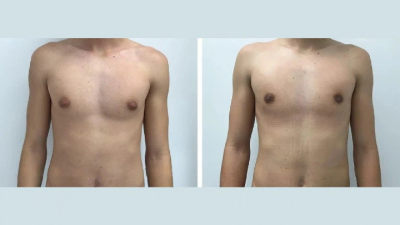 Top Qualities of Best Gynecomastia Surgeon in dubai