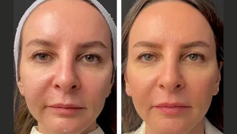 Why Choosing the Best Plastic Surgeon in Dubai Matters for Mesotherapy Treatments