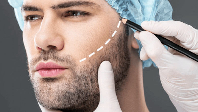 Beard Transplants: A Step-by-Step Guide