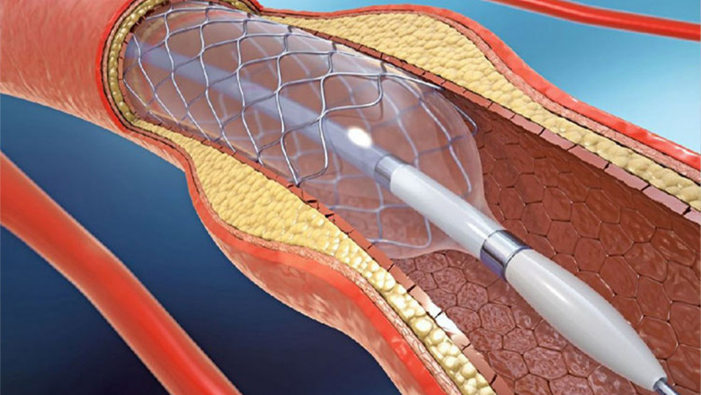 Carotid Artery Stent Market to Surge with Next-Gen Implant Technology