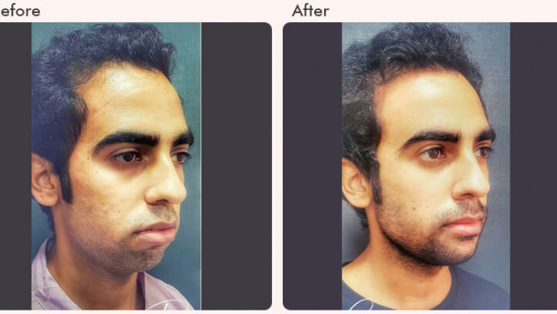 Chin implant surgery cost in Delhi - Dr Rajat Gupta