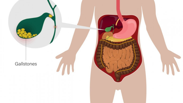 Gall-Bladder Stone Treatment in Bangalore – Causes, Symptoms &amp; Best Options